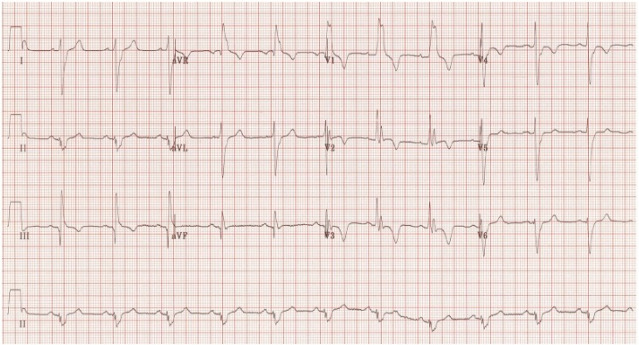 ECG