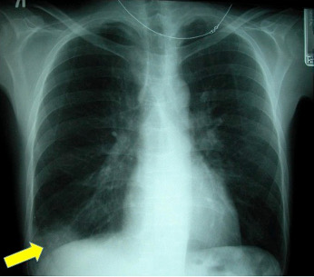 Chest X-ray 