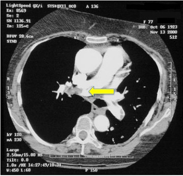 CT pulmonary angiography