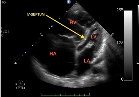 Echocardiogram 